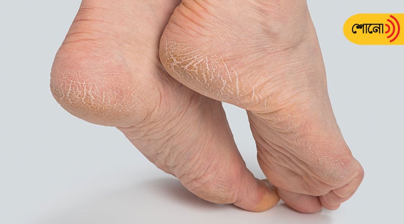 how to fix cracked feet in winter