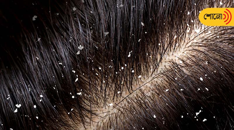 How to deal with dandruff