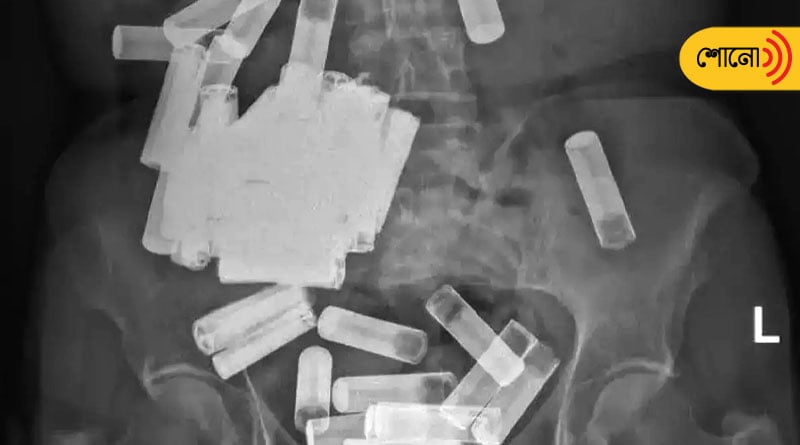 Doctors remove 55 batteries from woman's stomach and gut