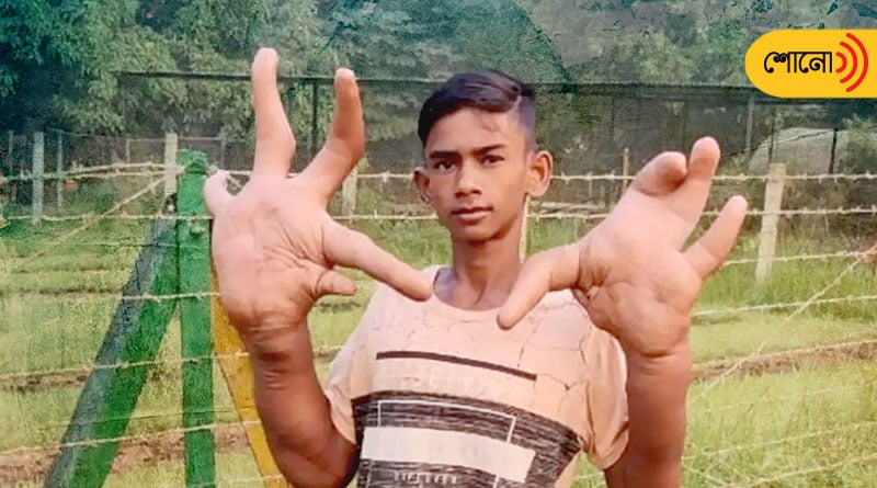 Jharkhand boy has 2-foot-long hands due to rare condition